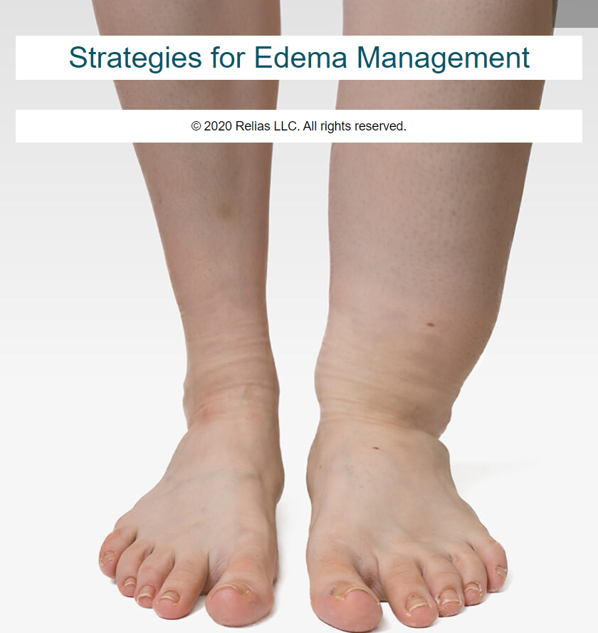 edema shoes for swollen feet