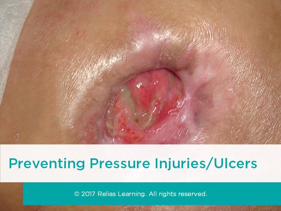 Preventing Pressure Injuries/Ulcers
