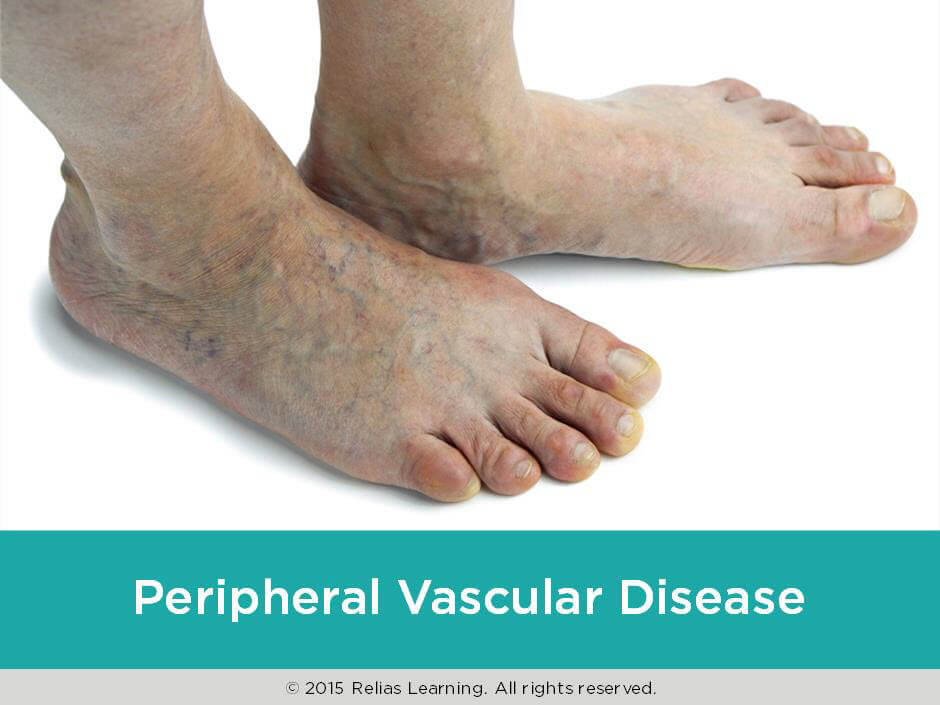 Peripheral Vascular Disease | RELIAS ACADEMY